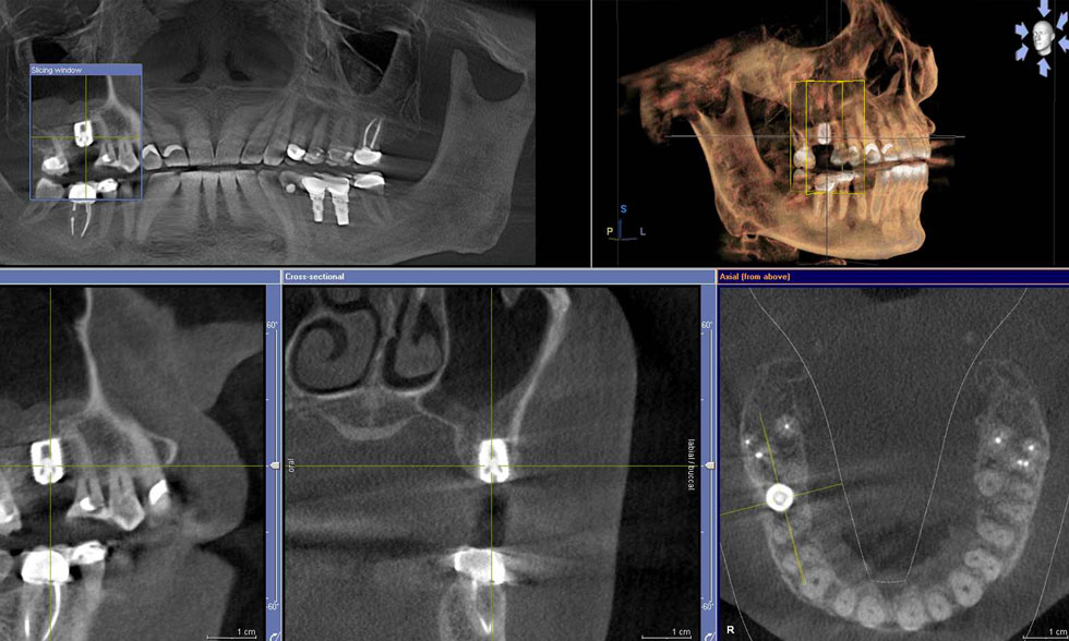 3D scan Implant Planning
