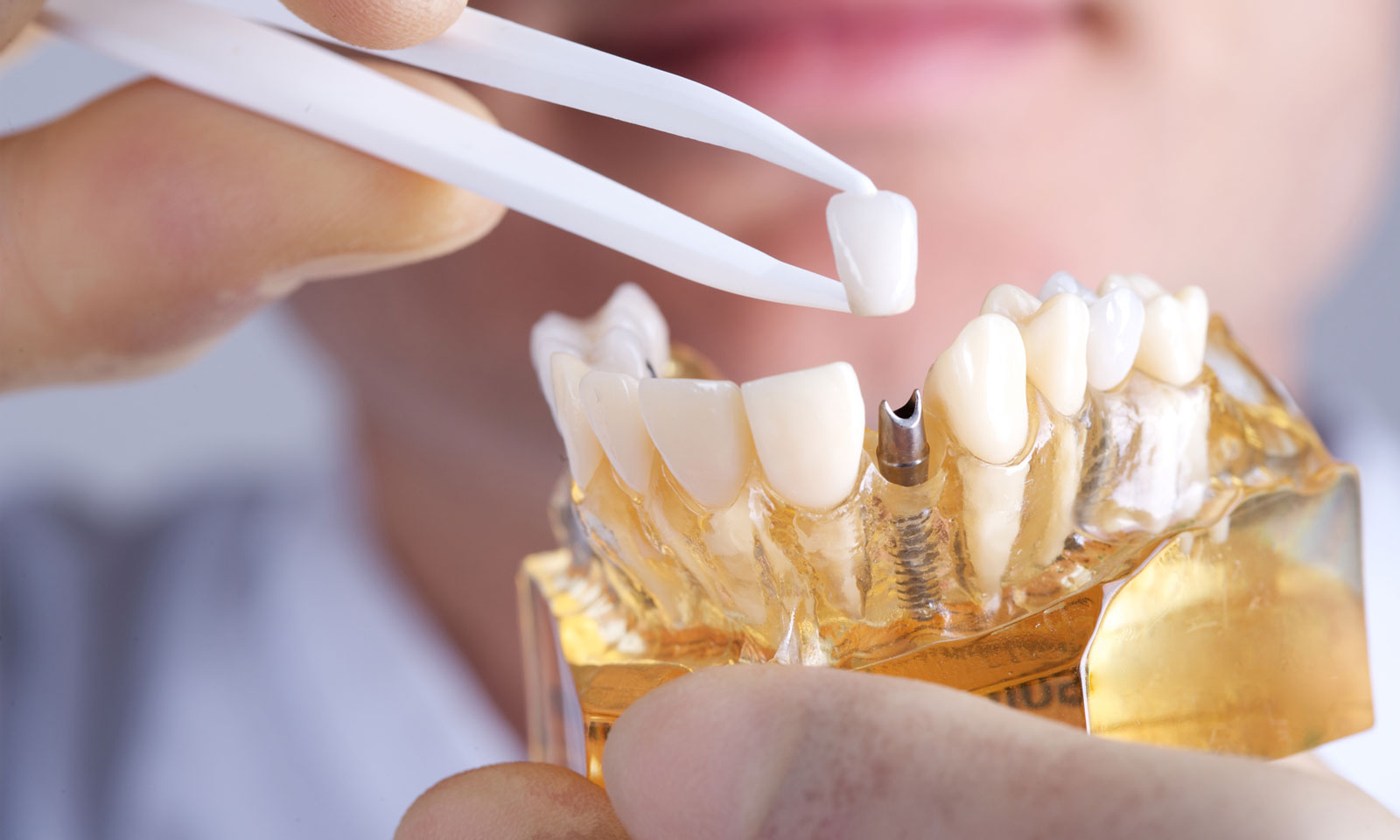 Prosthetics for Missing Teeth