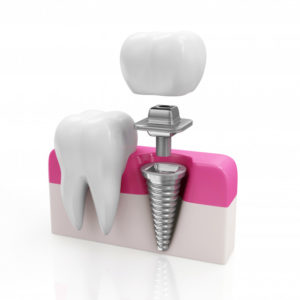 Important Facts About Dental Implants