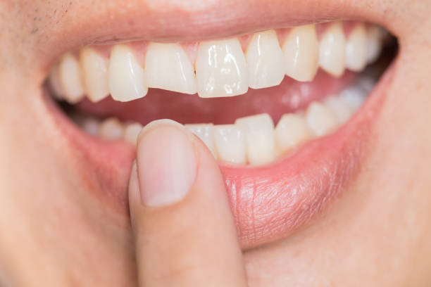 금이 간 치아가 저절로 치유될 수 있습니까?